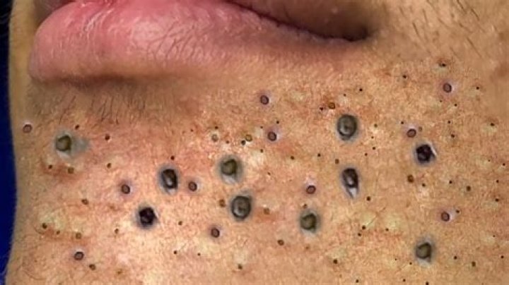 Biggest Blackhead Ever: Unveiling the Shocking Truth About Severe Blackheads